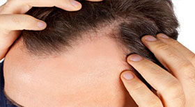 treatment of Alopecia